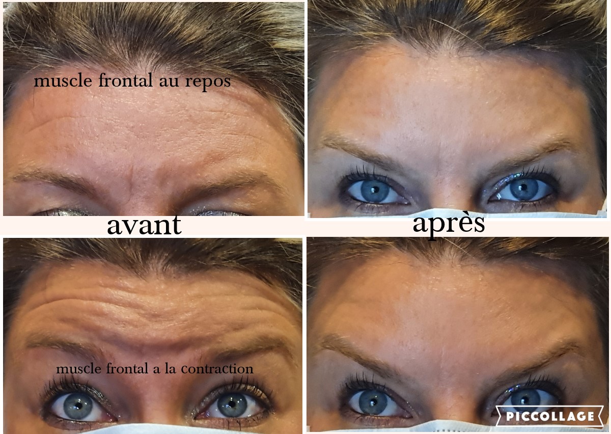 Injection de toxine botulique - Rides du front