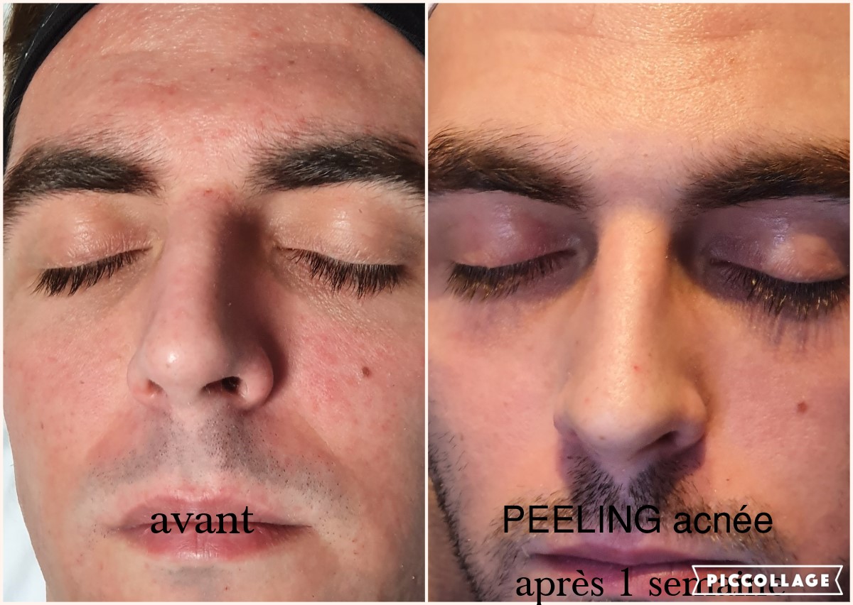Traitement peeling chimique professionnel